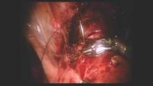 Robot-assisted repair of isthmocele resection.