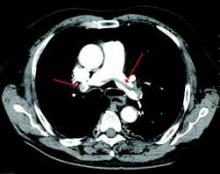 A large pulmonary embolism at the bifurcation of the pulmonary artery (saddle embolism).