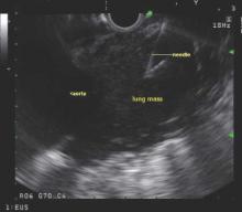 A biopsy window is found and an FNA needle advanced into the mass with EUS guidance.