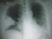 One of the most common causes of death from waterborne illness was Pseudomonas pneumonia.