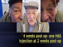 The same patient is 4 weeks postop, after receiving one hyaluronidase injection 2 weeks postop.