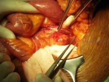 This image showws an open repair of an abdominal aortic aneurysm.