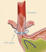 Magnets in the LINX device open temporarily to allow food to pass, while helping the lower esophageal sphincter resist opening and prevent reflux from the stomach into the esophagus.