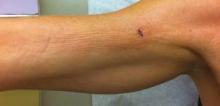 An 18×4-cm, brownish, rectangular, sclerotic, bound-down, hypertrophic plaque that started on the right mid forearm and extended to the right shoulder.