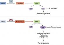 Proposed mechanism of tumorigenesis in hereditary leiomyomatosis and renal cell carcinoma syndrome. In the presence of functional fumarate hydratase (FH), hypoxia-inducible factor (HIF) is degraded, resulting in normoxia (top panel). In the absence of functional FH, there is accumulation of fumarate, while malate levels decrease, and the glucose metabolism through Krebs cycle shifts toward anaerobic glycolysis, even when sufficient oxygen is present to support respiration (bottom panel). Increased fumarate inhibits HIF prolyl hydroxylase (HPH), which leads to stabilization of HIF, a transcription factor, that enhances anaerobic glycolysis, cellular proliferation, and angiogenesis, leading to tumor growth. 