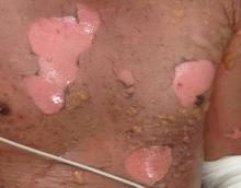 Figure 1. A second-degree burn with associated severe pain, tenderness, serous-filled bullae, deep rubor, erosion, and exudation of the chest. 