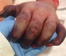 Figure 2. Cutaneous signs of iatrogenic, vasopressor-induced ischemia; gangrene of the distal digits of the left hand; and pronounced demarcation of vessels, as well as a vascular indication of thrombosis and lack of blood flow to the affected areas. 
