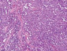 Figure 4. Slitlike vascular spaces lined by hyperchromatic endothelial cells in angiosarcoma (H&E, original magnification ×100).