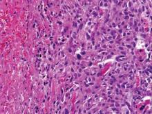 Figure 4. High-power view of the tumor from the amputation specimen showed sheets of epithelioid and polygonal cells displaying marked nuclear pleomorphism and scattered mitoses (H&E, original magnification ×400).