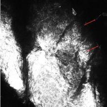 Branching hyphae (red arrows) seen in the epidermis on reflectance confocal microscopy.