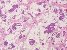 Figure 6. Mucinous carcinoma is characterized by delicate fibrous septa enclosing large lakes of mucin containing islands of tumor cells (H&E, original magnification ×20).