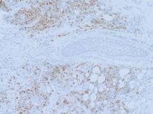  Figure 4. Myeloperoxidase stain highlighted lesional cells (original magnification ×10). 