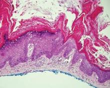 Figure 4. Parakeratosis and pagetoid spread of cells adjacent to areas of full-thickness epidermal keratinocyte atypia in Bowen disease (H&E, original magnification ×10).