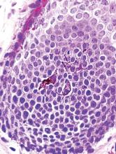 Figure 5. A hair bulb of a normal follicle showing the morphology of melanocytes, which are dendritic and large (H&E,original magnification ×100).