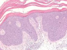 Figure 4. The epidermis is acanthotic and shows full-thickness disorderly maturation of keratinocytes, mitoses at different levels, and dyskeratotic cells in a squamous cell carcinoma in situ. Overlying parakeratosis also can be noted (H&E, original magnification ×100).