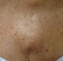 Figure 1. Nontender nonmobile subcutaneous mass located overlying the right mid sternum.