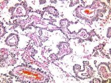 A histology of a dysgerminoma of the ovary.