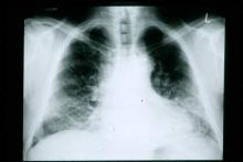 Scan shows lungs of patient suffering from idopathic pulmonary fibrosis.