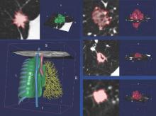 Automated segmentations of a lung nodule created from a CT lung scan.