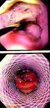 Stent placement is safe and effective.