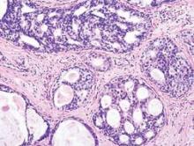 Histopathologic image from ductal cell carcinoma in situ (DCIS) of breast. Hematoxylin-eosin stain.