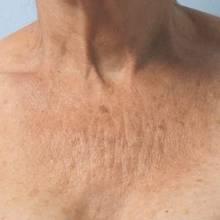 Patient's decolletage prior to undergoing treatment with micro-focused ultrasound.