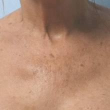 A reduction in the appearance of wrinkles and lines was noted after one treatment.
