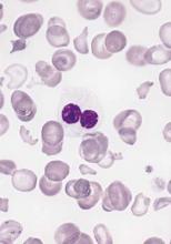 Blood smear from an adult female with a myelodysplastic syndrome. A hypogranular neutrophil with a pseudo-Pelger-Huet nucleus is shown.