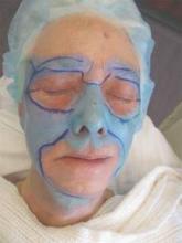 A woman receives a TCA Blue Peel of the face, ears, and feathering onto the neck.