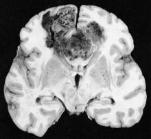 This typical untreated glioblastoma, here with the classic 'butterfly' configuration, is a necrotic hemorrhagic mass.