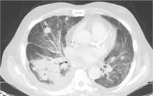 CT of the chest demonstrates numerous pulmonary nodules, air bronchograms, and reticulonodular infiltrates image