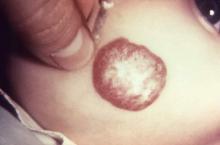  cavernous strawberry hemangioma