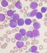 This image shows a Wright's stained bone marrow aspirate smear of patient with precursor B-cell acute lymphoblastic leukemia.