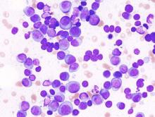 Histopathological image of multiple myoloma. Smear preparation of bone marrow aspirate stained with May-Grünwald-Giemsa procedure.