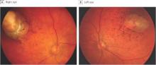 These are fundus photographs of a 1-month-old boy. The right (A) and left (B) eyes have paramacular superotemporal round chorioretinal atrophy surrounded by a hyperpigmented halo and hyperpigmented mottling.