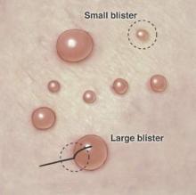 Figure 1. Punch biopsy of subepidermal blisters. For large blisters, a line is drawn with a surgical marker from the roof of the tense blister onto the surrounding perilesional skin. A punch biopsy is obtained from the edge of the blister with approximately 75% of the sample representing perilesional skin. For smaller blisters, the entire blister is punch excised. Illustration by Kyle Cunningham, Biomedical Illustration Services at the University of Mississippi Medical Center (Jackson, Mississippi). 