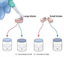 Figure 3. Punch biopsy of subepidermal blisters. Specimens from large blisters are bisected at the bedside with a no. 15 blade following the line drawn previously to ensure that perilesional skin and the “take-off point” of the blister will be visible when the cut edge is properly embedded in the laboratory. Excisional punch biopsies of small blisters are simply bisected. Half of each specimen is placed in formalin for hematoxylin and eosin processing, and half is placed in Zeus (or Michel) medium for direct immunofluorescence. Illustration by Kyle Cunningham, Biomedical Illustration Services at the University of Mississippi Medical Center (Jackson, Mississippi).  