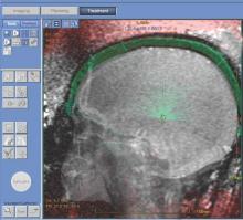 MRI guides focused ultrasound beams to thermally ablate the thalamus of a patient with essential tremor.