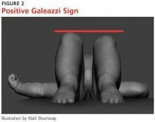 Positive Galeazzi Sign image