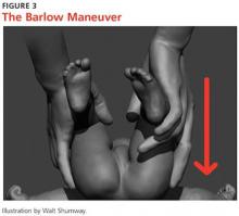 The Barlow Maneuver image