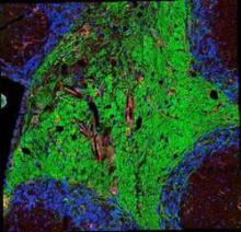 This is the cerebellum from an animal early in the demyelinating phase of the late-onset disease. The green marks myelinated axons and the red highlights areas of inflammation and demyelination.