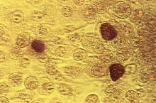 This photomicrograph reveals McCoy cell monolayers with Chlamydia trachomatis inclusion bodies; Magnified 200X.