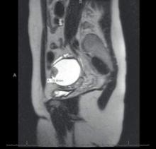 MRI view of an endometrioma with a malignant mural nodule.