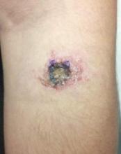 Figure 1. Nonhealing, pink, crusted plaque with central ulceration on the left volar forearm. 