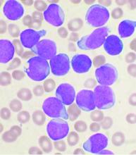 This image shows a Wright's stained bone marrow aspirate smear from a patient with precursor B-cell acute lymphoblastic leukemia.