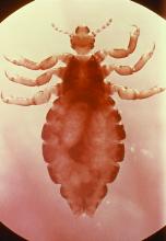 Pediculus humanus var. capitis, the head louse, is an insect of the order Anoplura and is an ectoparasite whose only host is humans. The louse feeds on blood several times daily, and resides close to the scalp to maintain its body temperature.