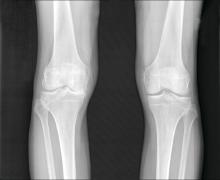 An x-ray of osteoarthritis in the knees