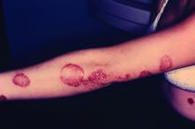 Psoriasis on the arm