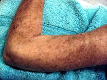 An arm of a woman with scleroderma