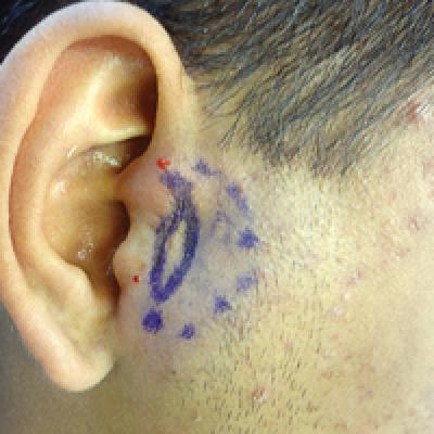 Diagnosis of a Rapidly Growing Preauricular Nodule: Chondroid 